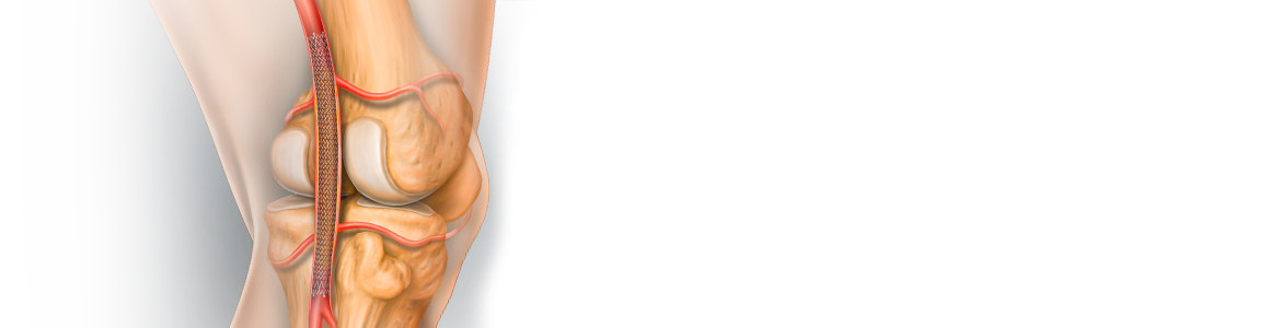 LifeStent® 5F Vascular Stent System